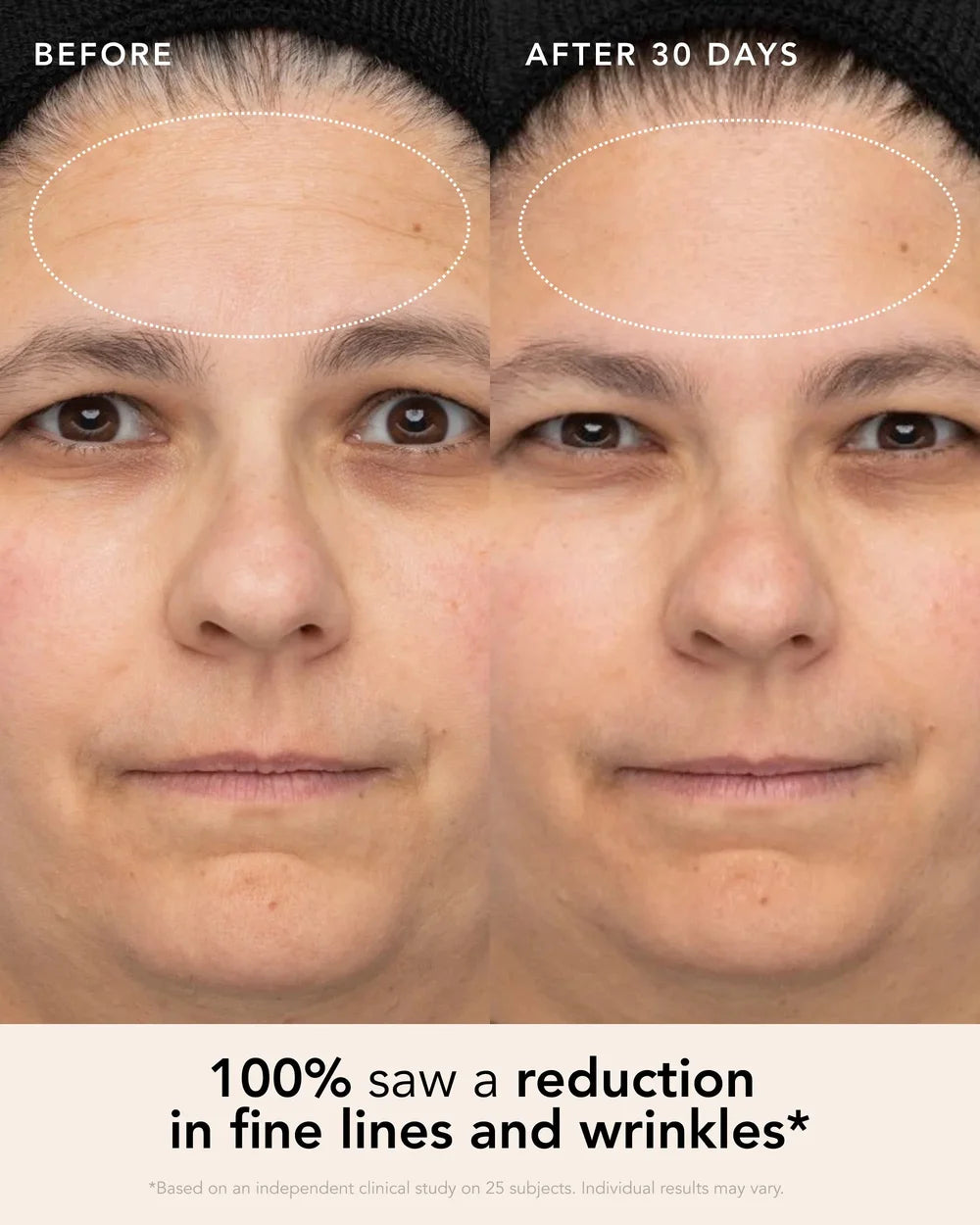 Vorher-Nachher-Bild mit sichtbar glatter wirkender Haut nach Ranavat Firming Bakuchi Serum