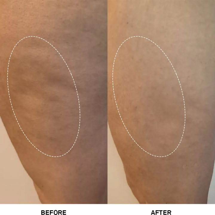 Firming Cellulite Cream von Team Dr Joseph - Vergleichsfoto Vorher und Nachher